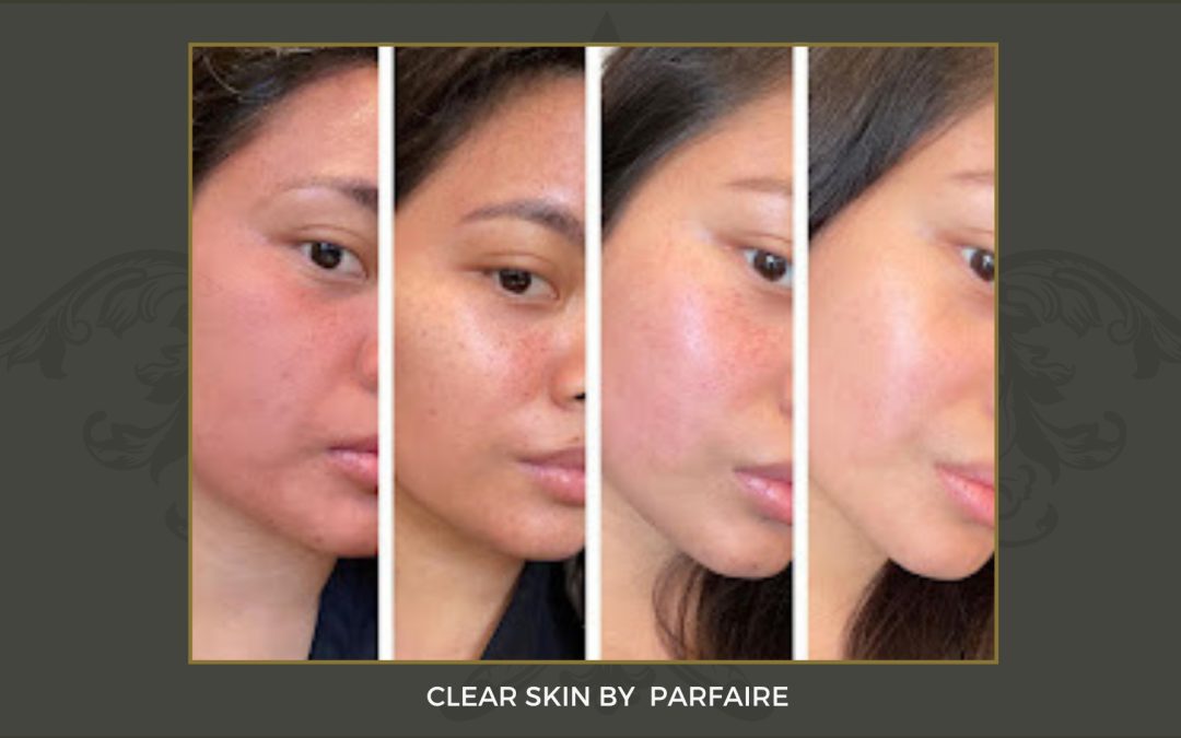 clearskin