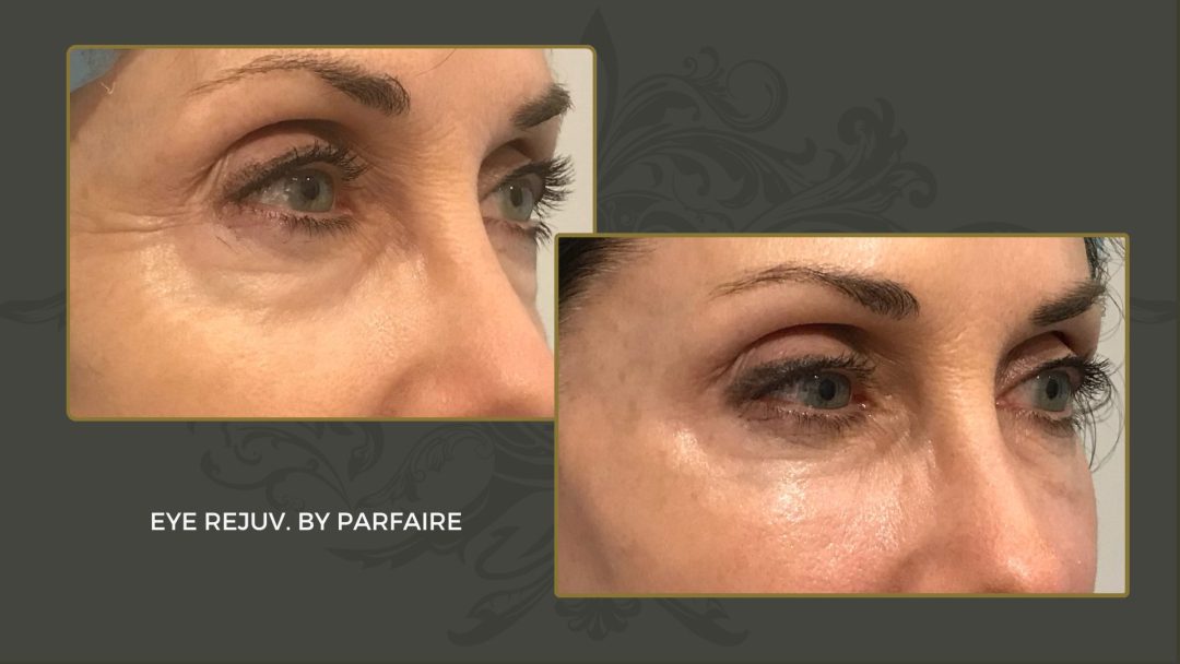 eye rejuv