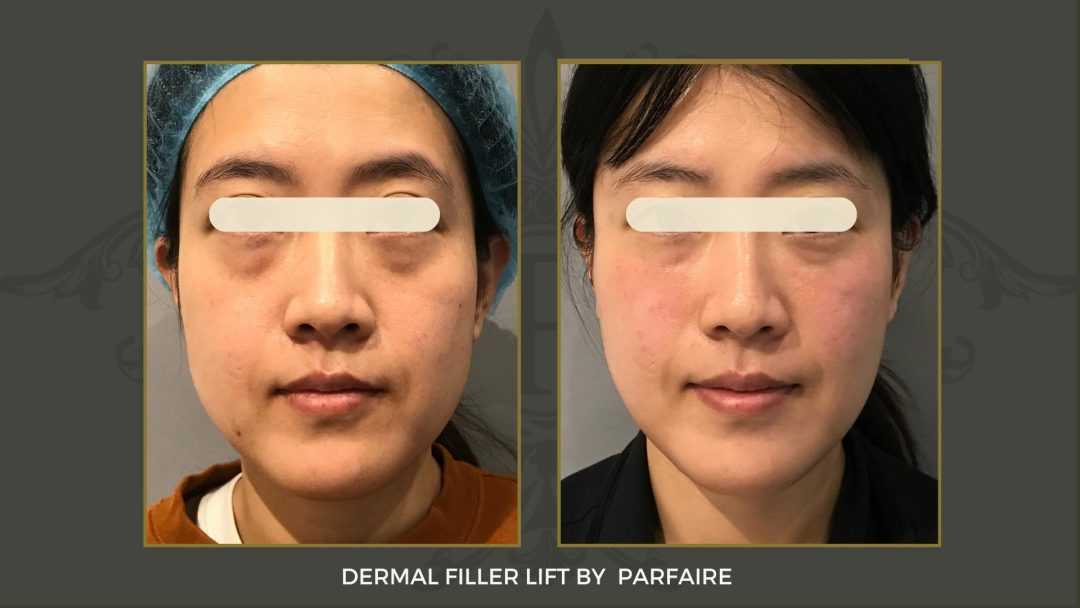 filler lift