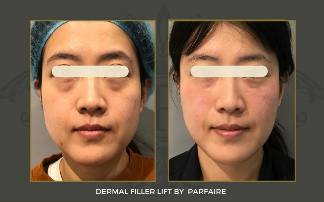 filler lift