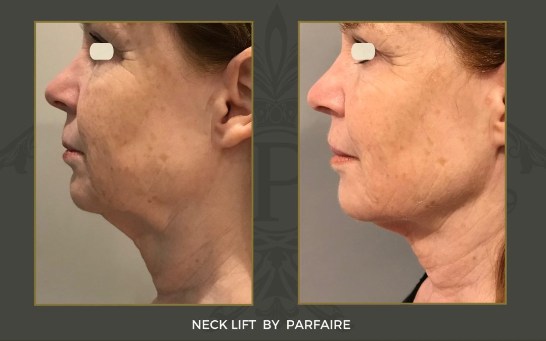 Neck lift