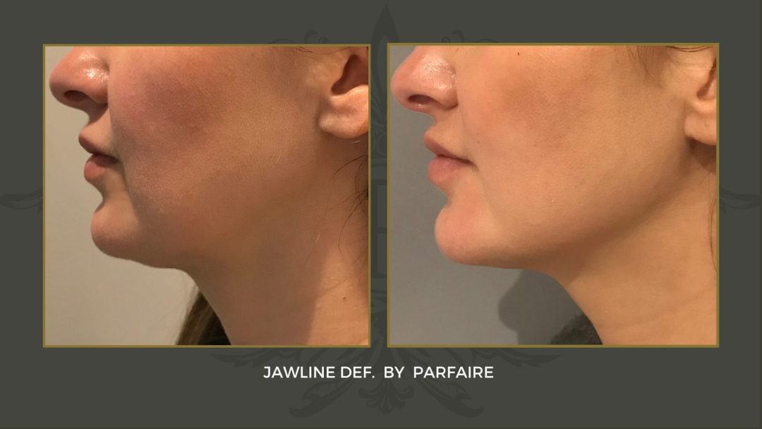 jawline def