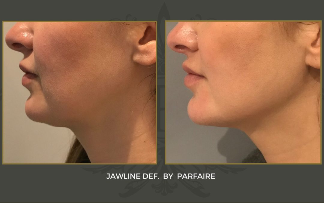 Jawline def