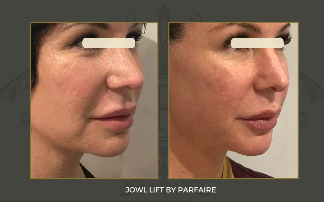 Jowl lift