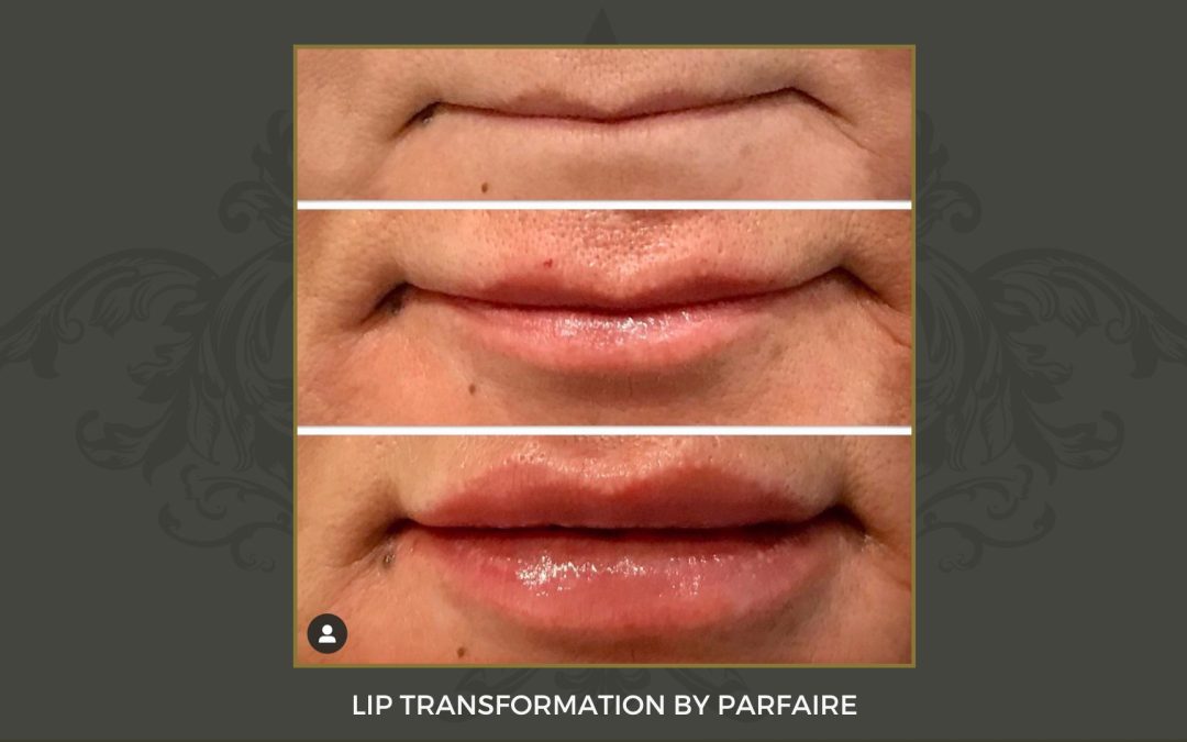 lip trans