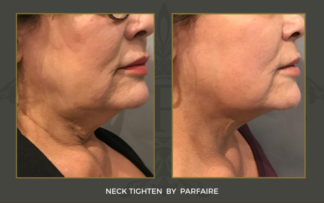 neck tighten