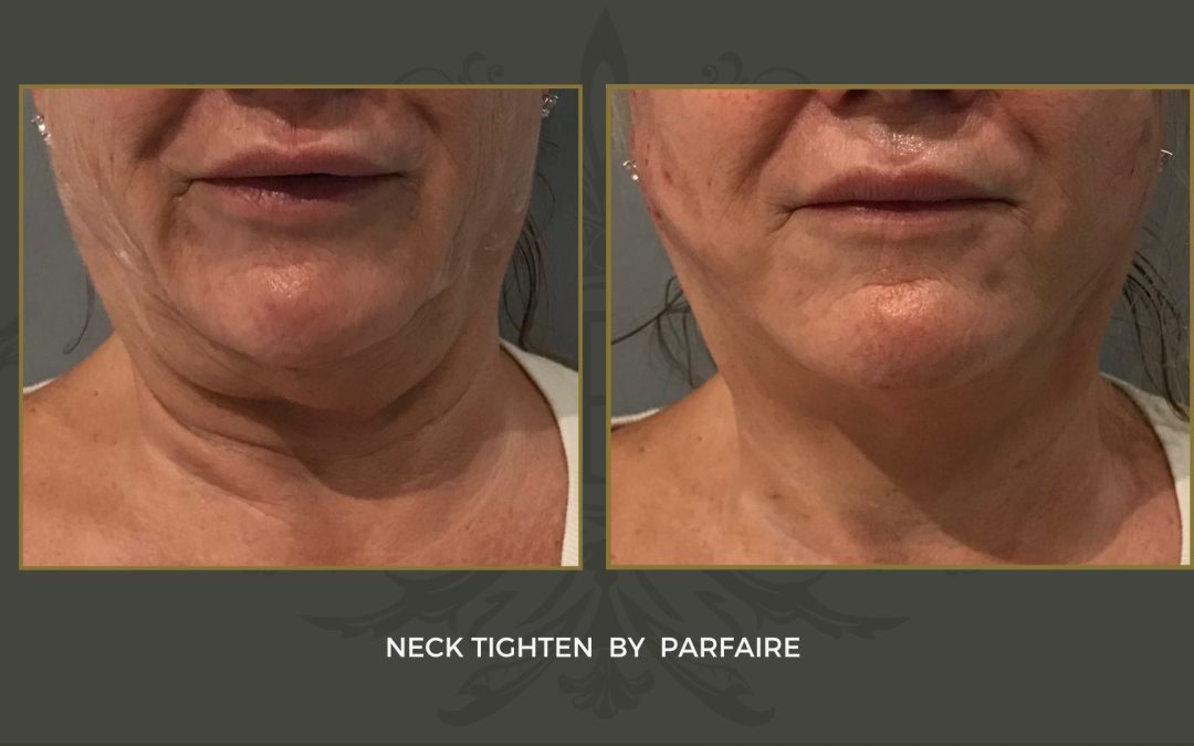 neck tighten