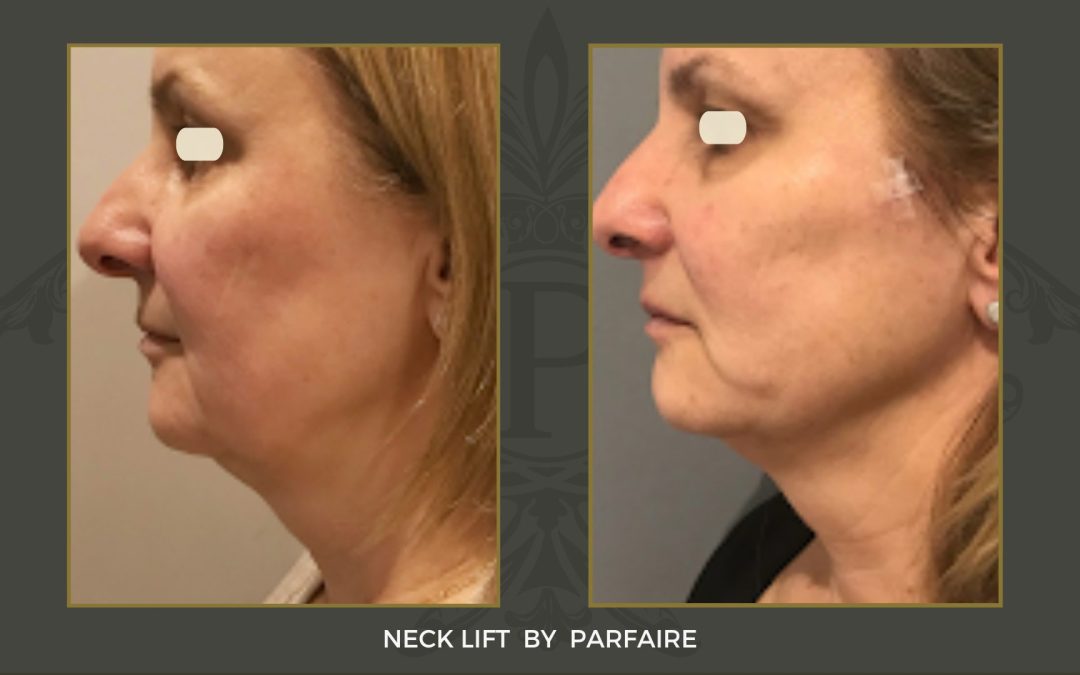 necklift2